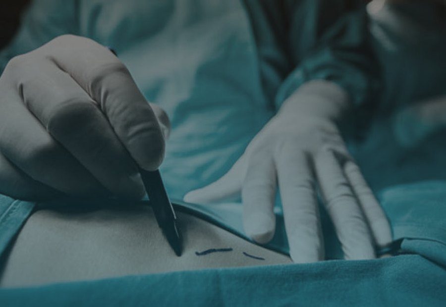 Chirurgie du lipœdème